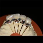 Aesthetic Partial Denture Precision Attachments Medical Grade OEM