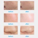 Professional 10 in 1 Hydra Dermabrasion Tightening with Certificate CE