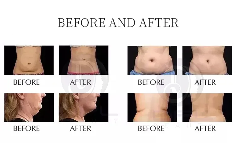 80K Body Contouring Rf 9 In 1 Ultrasonic Cavitation Machine Cellulite Removal Anti-Aging Skin Rejuvenation
