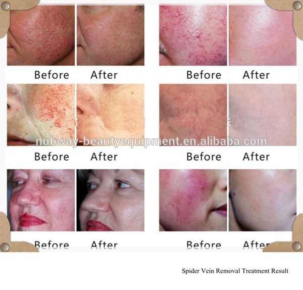 Spider Vein removal machine treatment result.jpg