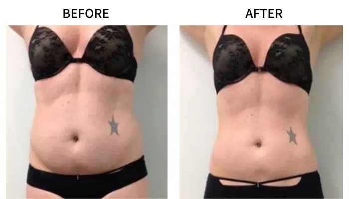 Luxmaster Emerald Laser 532nm Slimming Machine Body Sculpting Equipment Non Invasive