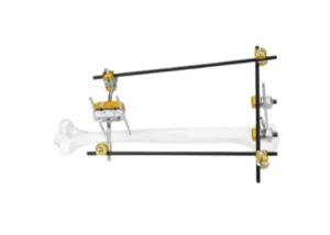 China Proximal Humerus Medical External Fixator factory