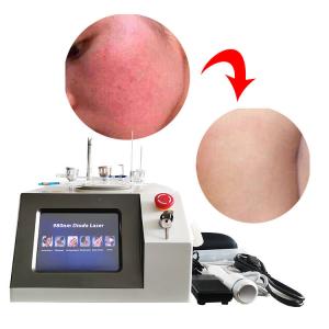 China 6 In 1 Spider Vein Laser Machine , 980nm Face Vascular Treatment Varicose Veins Machine factory