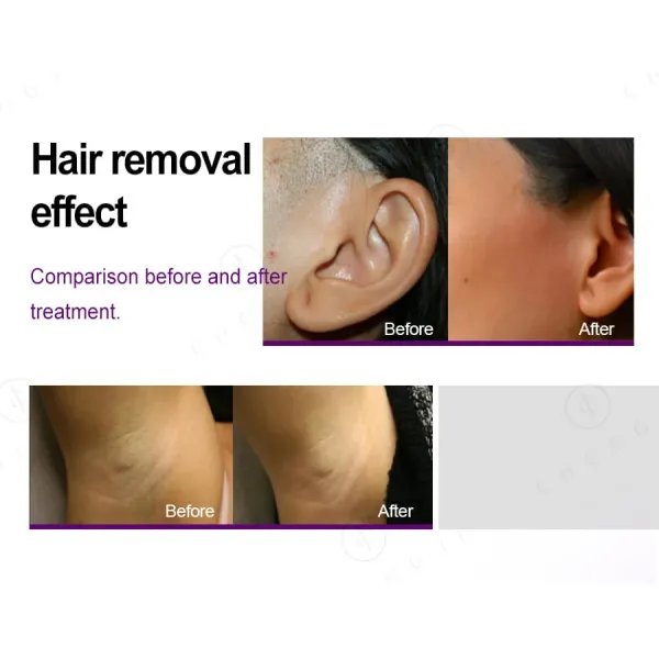 Platinum Ice Titanium Diode Laser Hair Removal Machine 2023 New 755 808 1064nm Diode Laser Ice Hair Removal Machine