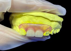 China Tailored Secure Fit invisible Flexible Parital Denture Replacement For Comfortable Chewing And Speaking factory