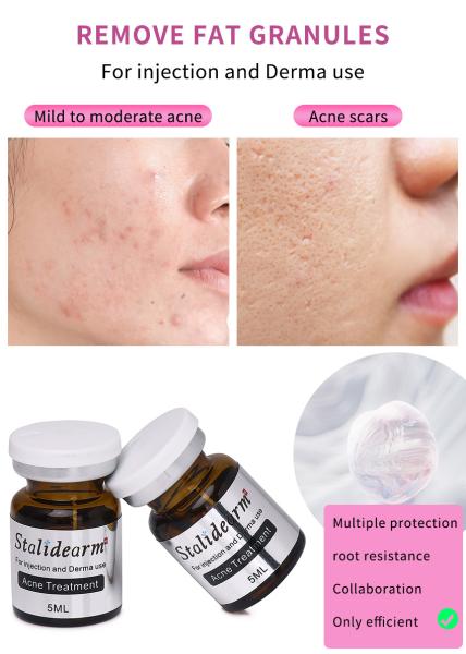 Factory Supply Skin Booster Pimples Repair Acne Treatment Blackhead Removal