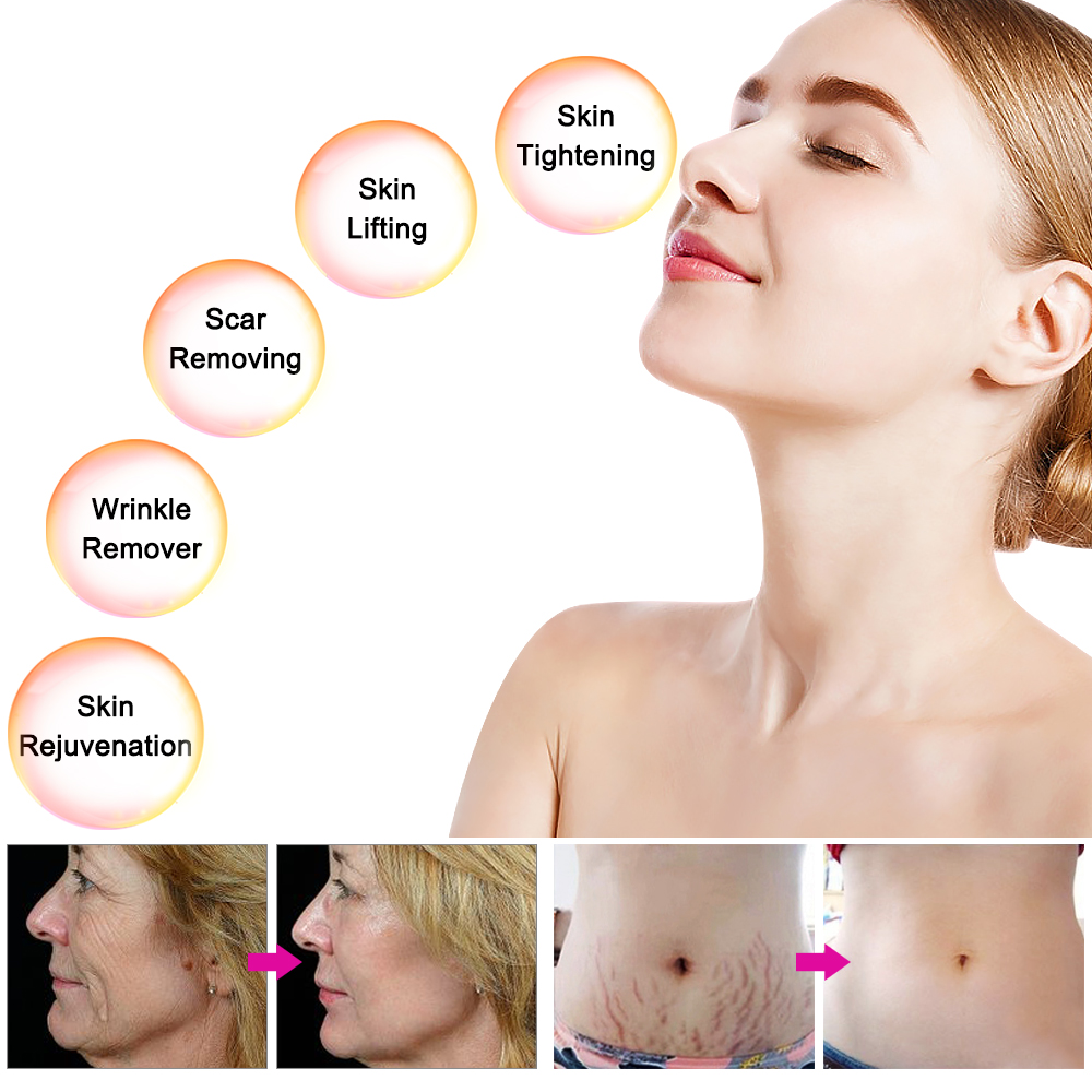 Commercial Skin Rejuvenation Beauty Rf Microneedle Rf Machine