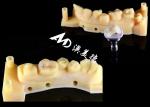Smooth Hypoallergenic Ceramic Inlays Onlays Custom Fit Stain Resistance High
