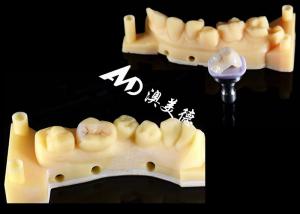 China Smooth Hypoallergenic Ceramic Inlays Onlays Custom Fit Stain Resistance High Durability factory
