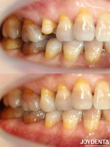 China Customizable Affordable Dental Inlay Restorative Precise Fit For Damaged Teeth factory