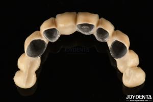 China PFM Ceramic Fused To Metal Crown High Biocompatible and Corrosion Resistant factory