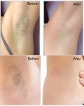 Non Pain 808nm Diode Laser Hair Removal Machine 400ms Pulse Width