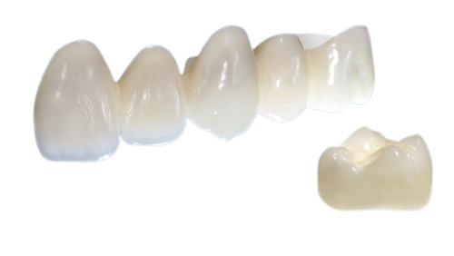 Porcelain Crowns Are Beautiful In Shape Lifelike In Color And Strong In