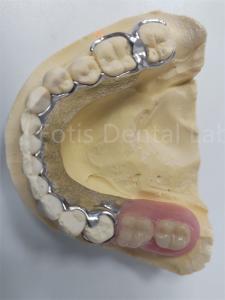 China Replace Missing Teeth Removable Partial Denture Dental Prosthesis Flexible Design factory