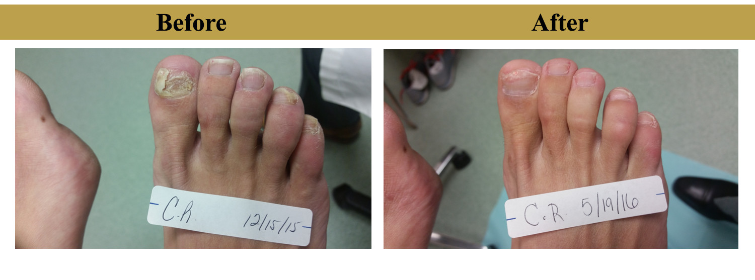 Class IV Podiatry Laser Onychomycosis Non Invasive Laser Treatment