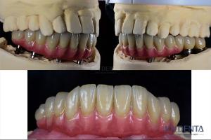 China Dental Reconstruction Multiple Teeth Implant Titanium Prosthetic Connection Internal factory