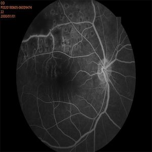 High Resolution Automated Fundus Camera with FFA or FAF, mosaic function
