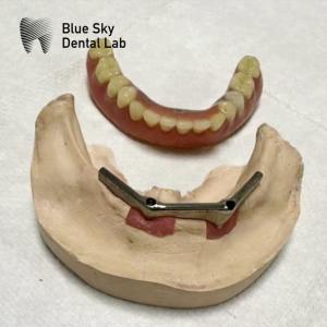 China Implant Overdenture Titanium Bar Dental Implant with removable denture factory