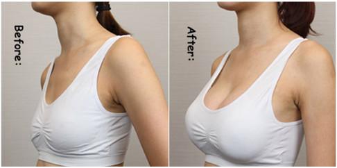 Injectable Hyaluronic Acid Ha Filler For Lips Facial Wrinkle Breast Enlargement