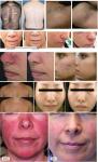 Beauty Salon Equipment Diode Laser E-light+ipl+rf Machine