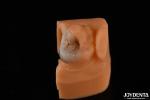 Custom Compound Inlay Onlay For Minimally Invasive Dental Restoration