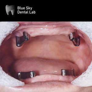 China Resin Teeth Dental Titanium Bar Removable Blue Sky Implant System factory