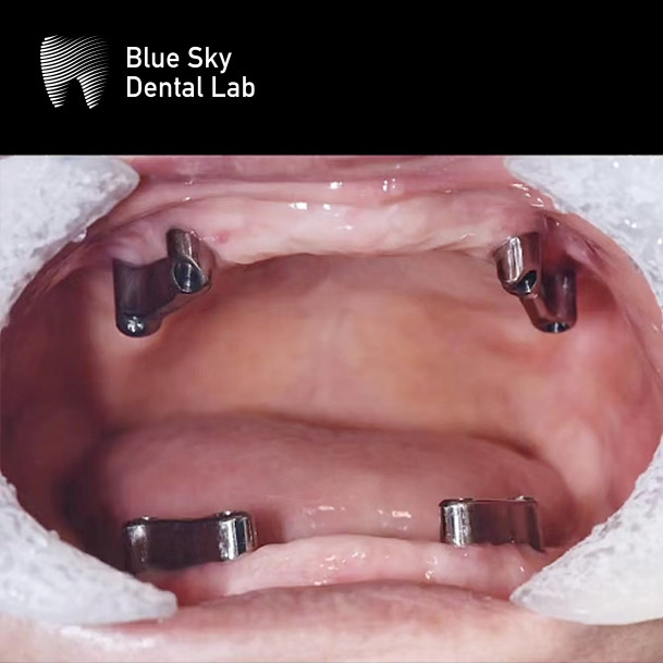 Implant Overdenture Titanium Bar Dental Implant with removable denture