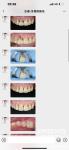 Smooth Surface Dental Tooth Zirconia Crown For Posterior And Anterior Restoratio