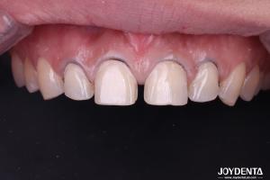 China Real Looking Dental Porcelain Veneers Perfectly Fit Ceramic Teeth Veneers For Front Teeth factory