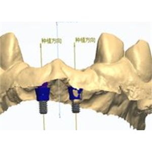 Natural-looking Zirconia Dental Crown with Excellent Biocompatibility and