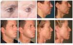 Skin Care Fractional Rf Microneedle Machine Body Radiofrequency Microneedle