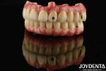 Hybrid Technology Titanium Malong Dental Bridge Adjustable For Aesthetic Results