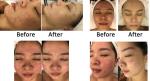 500W Mesotherapy Needle Free Machine Anti Aging Skin Whitening Machine