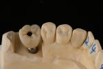 3.75mm Silver Titanium Screw Dental Implant Single Tooth Replacement Implant