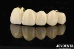 Excellent Strength Ti-Bar Zirconia Hybrid Bridge For Natural Teeth And Gums