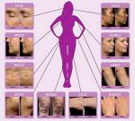 Most Popular CE Approved fractional microneedle rf for Acne Scars removal