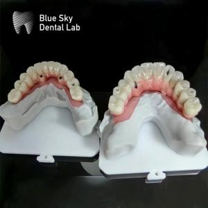 China Blue Sky Implant Full Arch Implant Cases Nature Implantation Cases factory