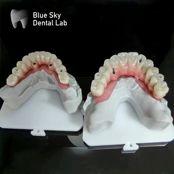 Universal Implant Procedure Cases Full Mouth Implant Case Customized
