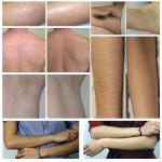 High Power Painless 755 808 1064nm Diode Laser Hair Removal Device