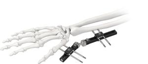 China Orthopedic Wrist External Fixator Standard Single sided Integrated factory