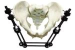 Pelvic Fracture Orthopedic External Fixator Implant Materials For Trauma