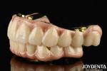 Excellent Strength Ti-Bar Zirconia Hybrid Bridge For Natural Teeth And Gums