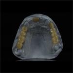 Removable Lower Upper Partial Acrylic Denture For Missing Teeth