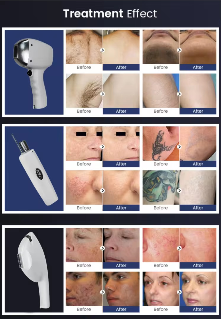 D31-3 Professional Ipl Hair Removal 808nm Diode Laser Carbon Peel Nd Yag Picosecond Laser With Measuring Rod