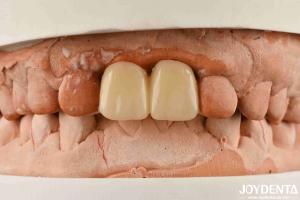China Multilayer PMMA Polymethyl Methacrylate For Dental Restorations factory