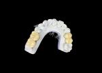 Zirconia PFZ Porcelain Dental Crown From Professional China Dental Lab