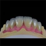 Dental Lab Teeth Feldspathic Porcelain Veneers Custom Shaped