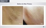 1-120J/CM2 180J/CM2 Diode Laser Machine 1000W 1600W Hair Removal Skin Rejuvenati