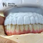 Universal Compatibility Implant Cases Customize Full Mouth Implant Case