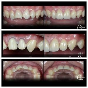 China Nature Dental Veneers For Natural And Beautiful Smile factory